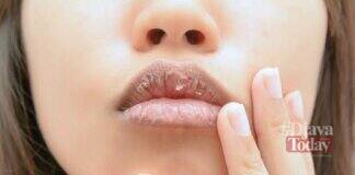 Cara Mengatasi Bibir Kering