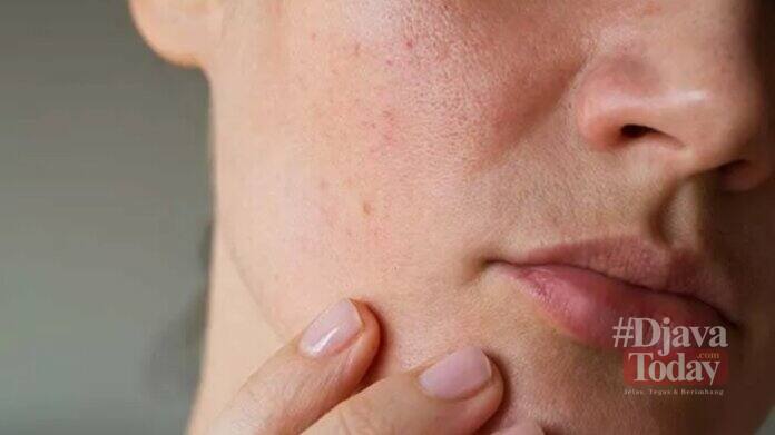 Tips mencegah kulit kering