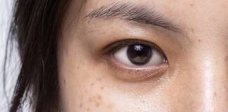 Menghilangkan dark spot