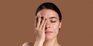 Cara Mengatasi Skin Barrier