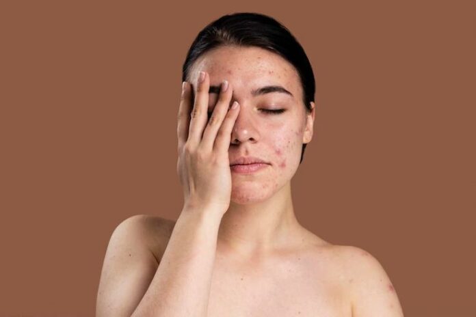 Cara Mengatasi Skin Barrier