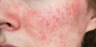 Penyebab Munculnya Rosacea